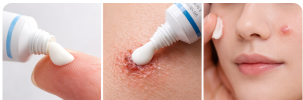 항생제 연고 활용