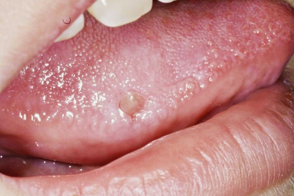 혓바늘이 돋는 이유 원인과 혓바늘 없애는 방법 꿀 치료법 자주돋는 현상