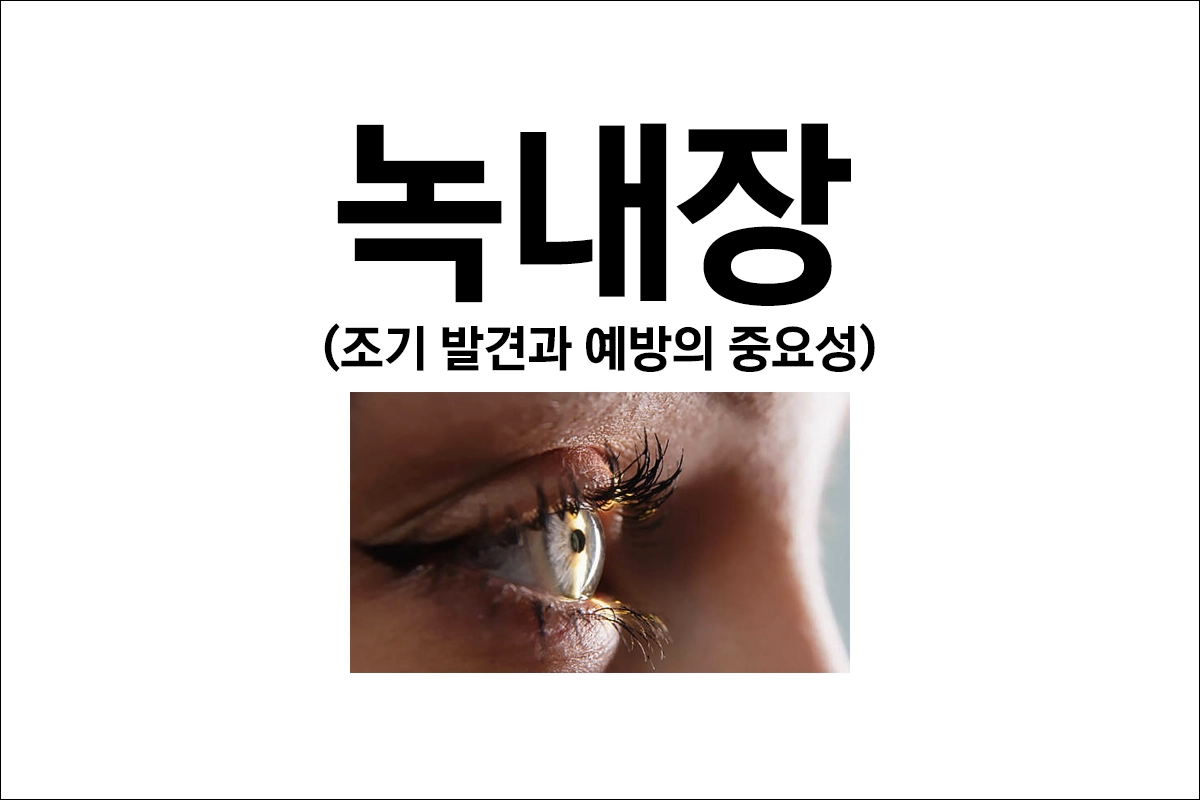 녹내장 조기 발견과 예방으로 눈 건강 지키기