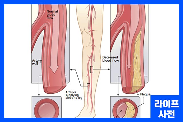 동맥을 좁혀 펌프 할 수 있는 혈액의 양을 줄이고 혈류를 감소시키며 다리가 저리는 원인을 유발