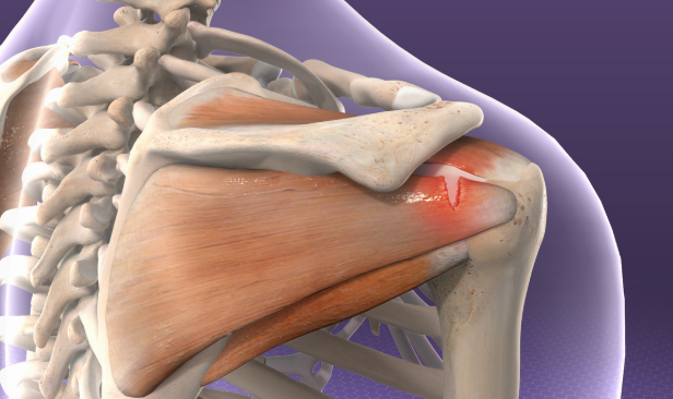 회전근개파열 수술후 회복기간