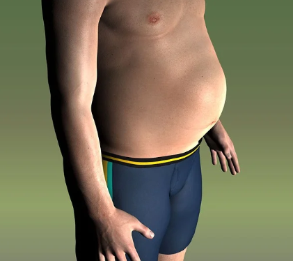 [배만 볼록한 원인] 배만 쏙 나온 마른 비만