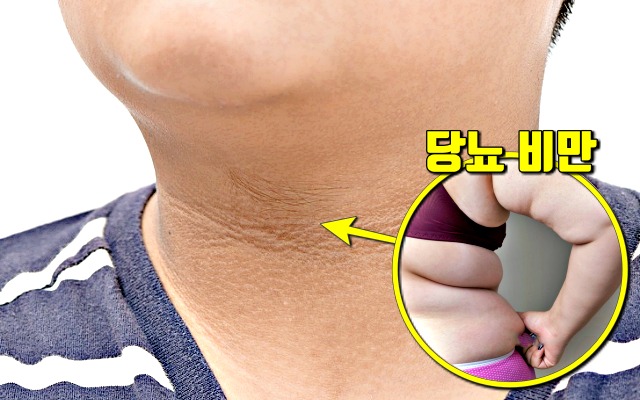 당뇨병 전단계 증상,피부 흑색가시세포증,생로병사의비밀