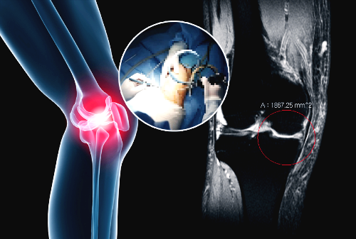 콘드로이친 효능 부작용