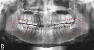 사랑니 발치 후 식사 가이드