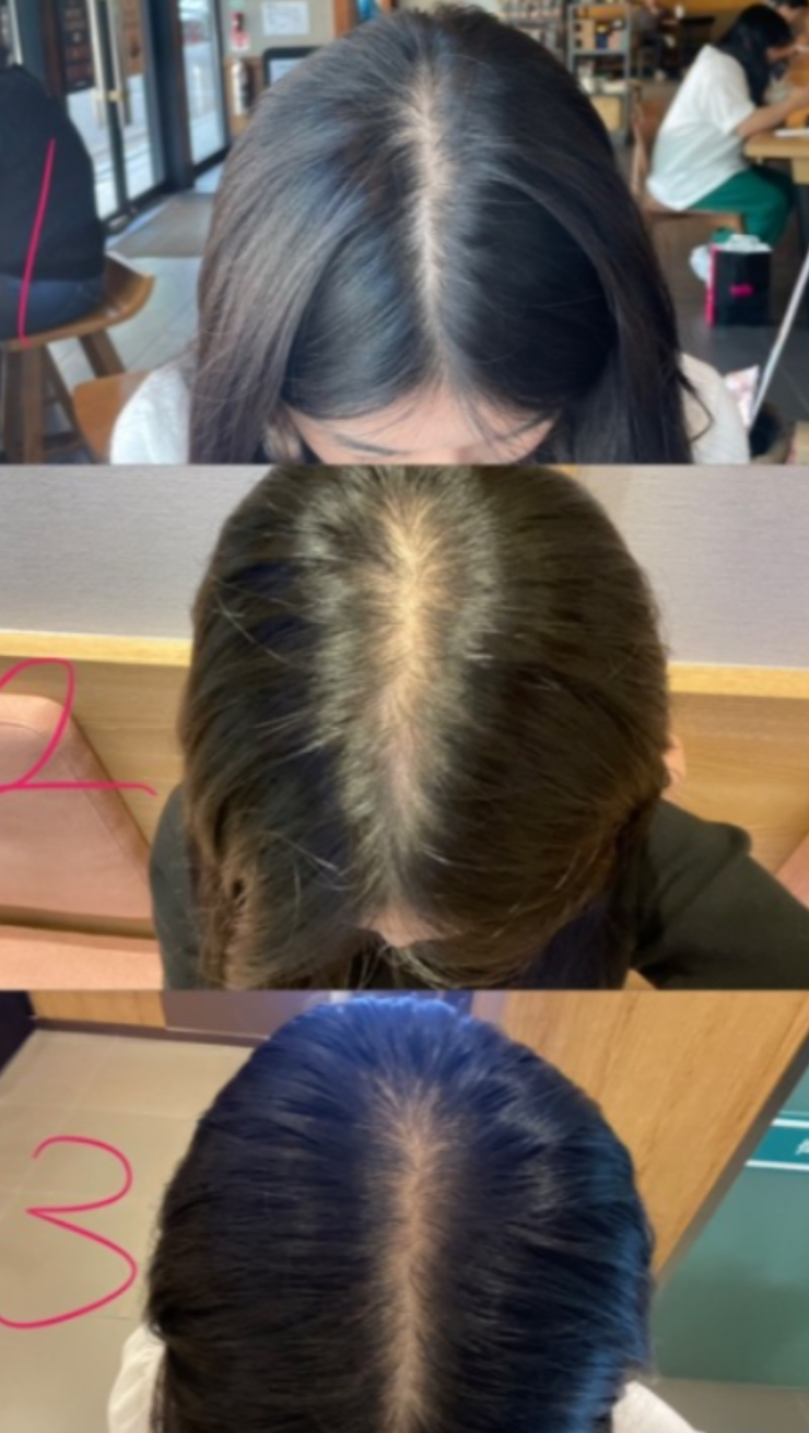 로게인폼 효과