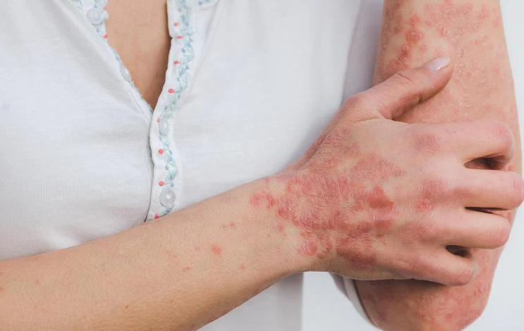 티트리 오일은 피부염증을 완화할 수 있습니다.