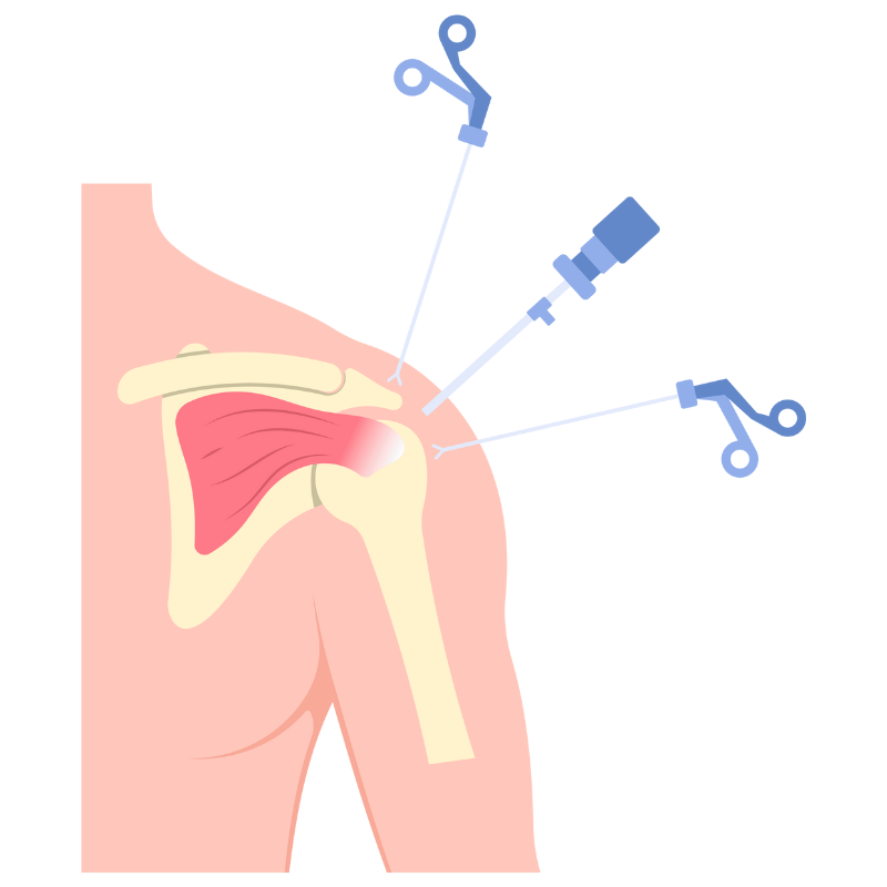 회전근개 파열 치료