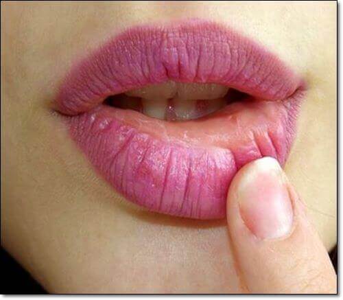 아시클로버 연고 주의점, 입술 헤르페스 발병한 임산부