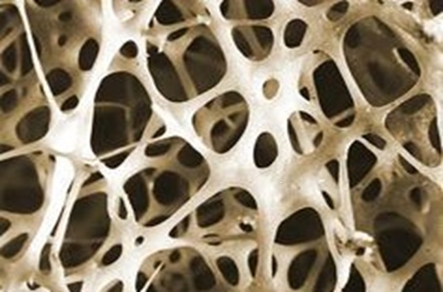 골다공증, 뼈가 무너지는 무서운 병 (골다공증의 위험성, 방치의 무서움, 예방 관리법)에 관한 설명을 하고 있습니다.