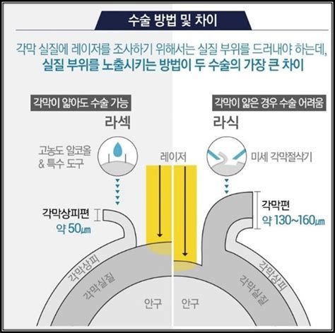 라식 수술이 가능한 나이