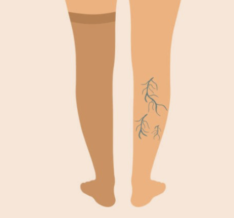 하지정맥류-수술비용