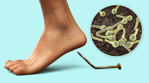 파상풍 초기증상 및 주사 기간과 아이들 예방접종 기간, 성인 예방접종 기간을 알아봤습니다. 파상풍은 우리가 생각하는 것보다 훨씬 위험한 질병이고 합병증이 무서운 질병이니 내용을 잘 숙지하기기 바랍니다.