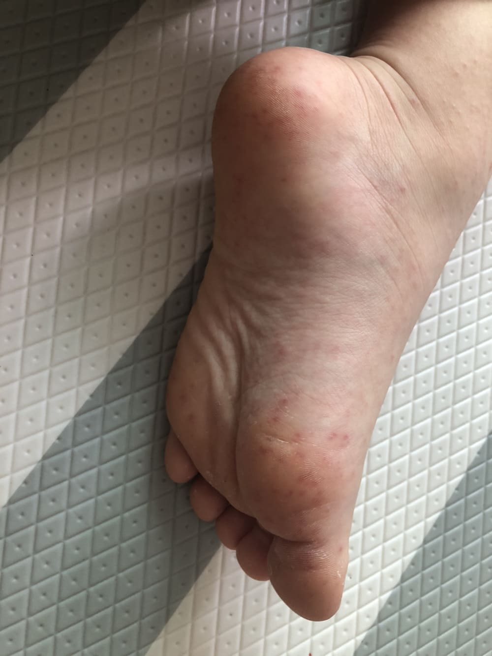 첫째아이 왼발붉은발진