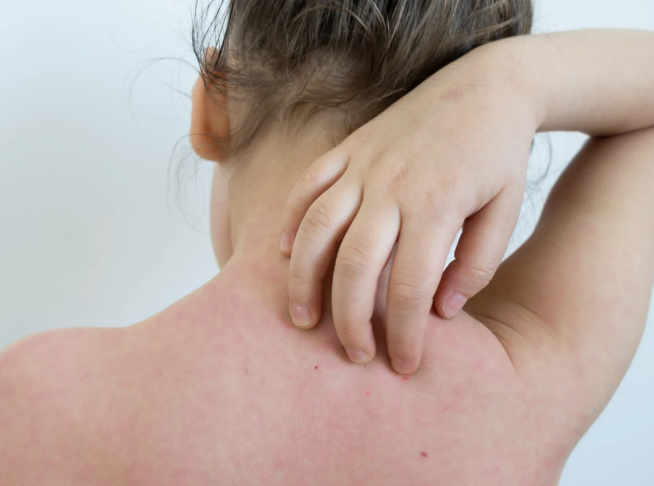 옴 증상과 원인 초기에 꼭 알아야 할 피부 감염 정보