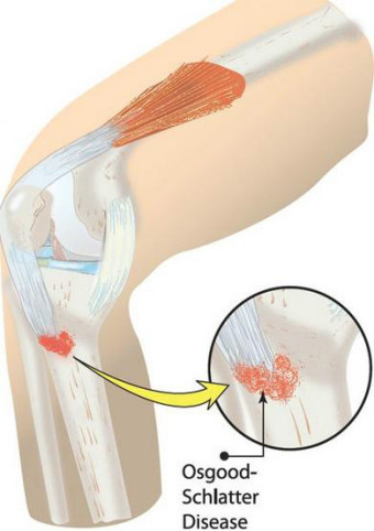 오스굿 슐래터2