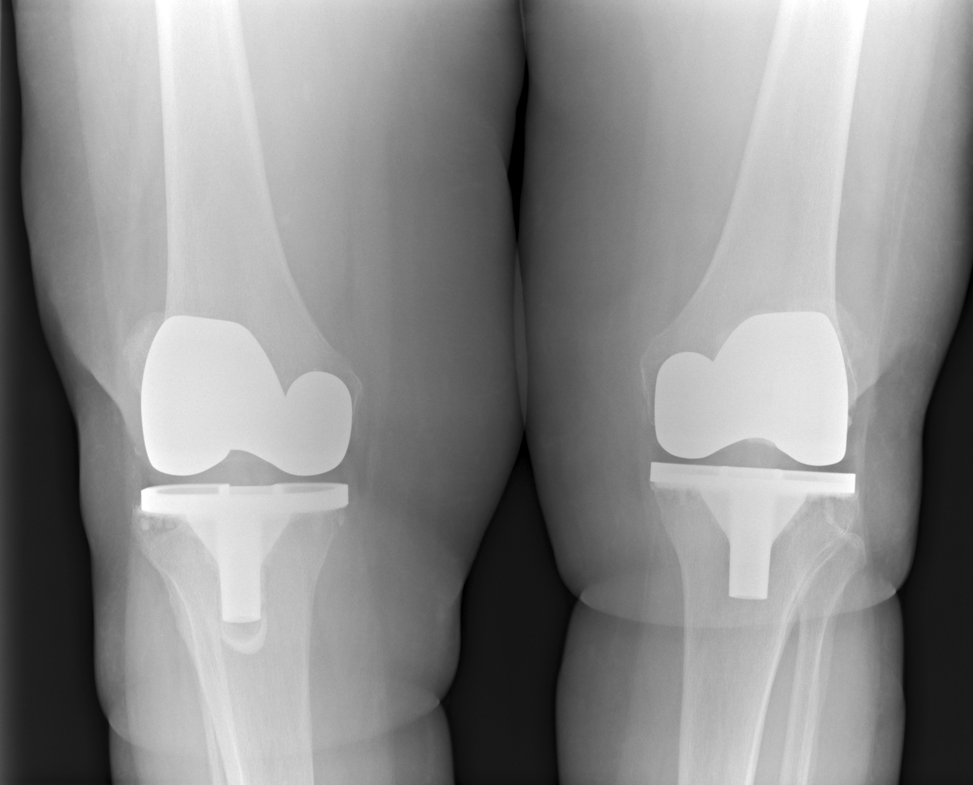 무릎인공관절 수술 후 찍은 x-ray 사진