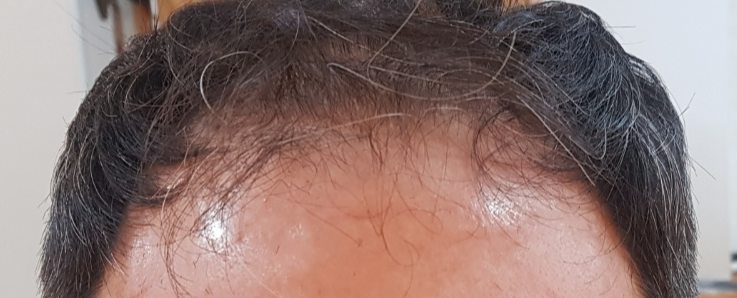 남자탈모 고민 원인을 알고 증상을 알고 근본적으로 해결해야 한다