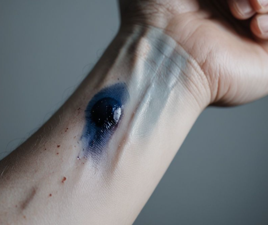 이유없는 멍이들때