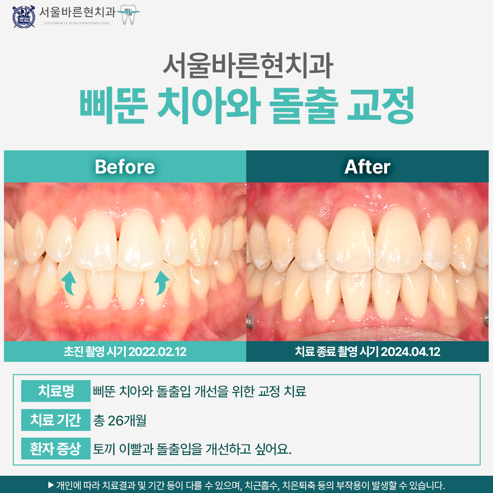 마린시티치아교정