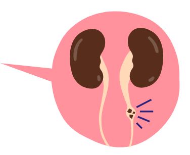 레몬물-효능-신장결석 예방 및 억제