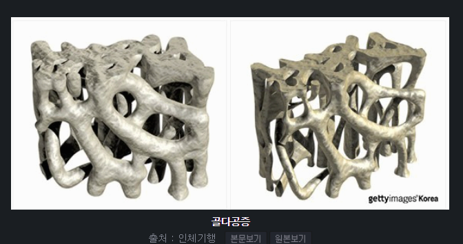 골다공증 주사란? 효과, 부작용, 치료 방법 총정리