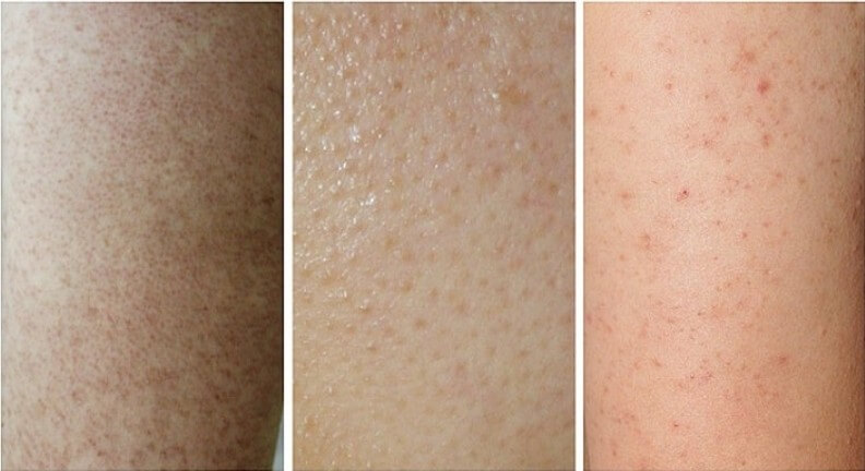 팔뚝에 생긴 모공각화증 치료 경과 모습