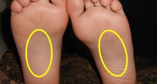 족저근막염 깔창 고르는 법