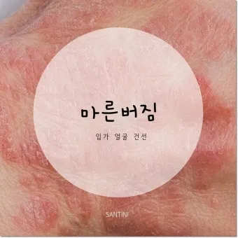 얼굴 버짐 증상 없애는 실전 방법 5가지 및 관리요령_20