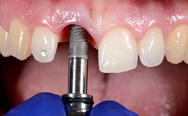 임플란트 시술과정