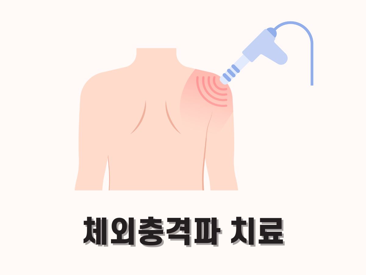 체외충격파 치료 원리, 효과, 비용 총정리