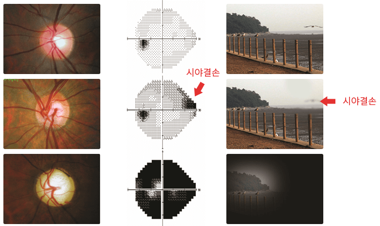 녹내장-증상