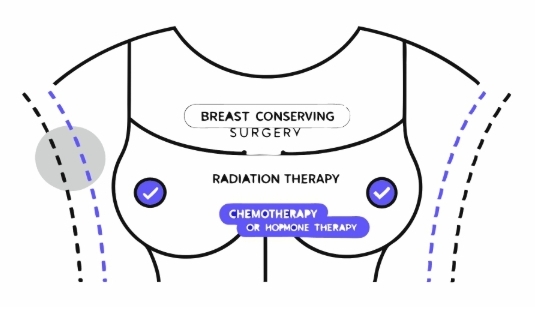 유방암1기 치료과정