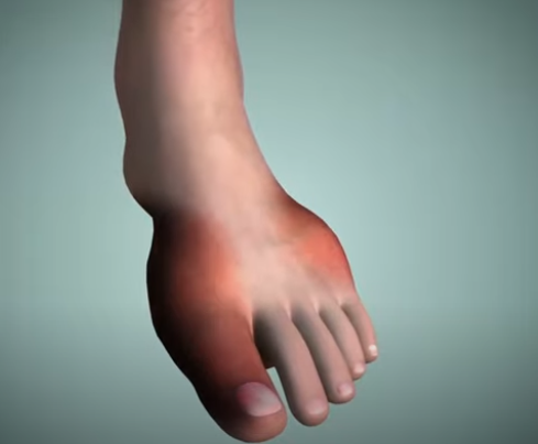 통풍 증상과 치료방법