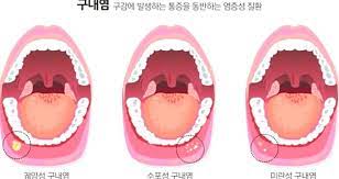 구내염