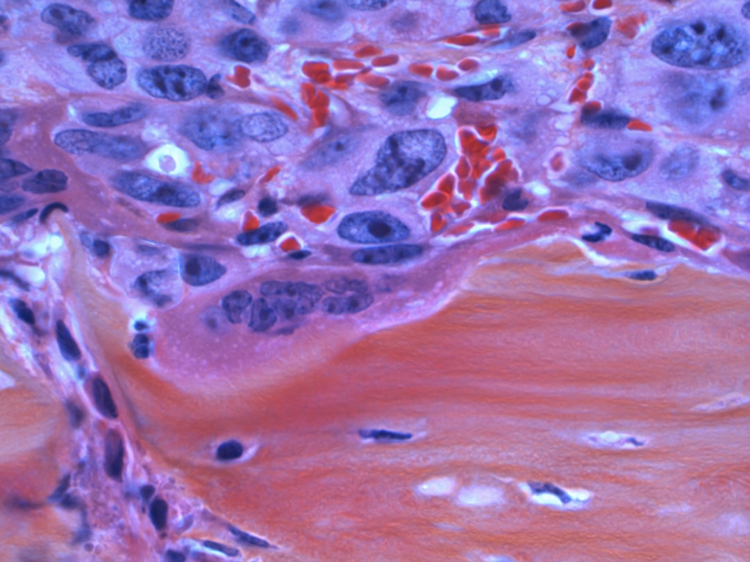 Hypothyroidism