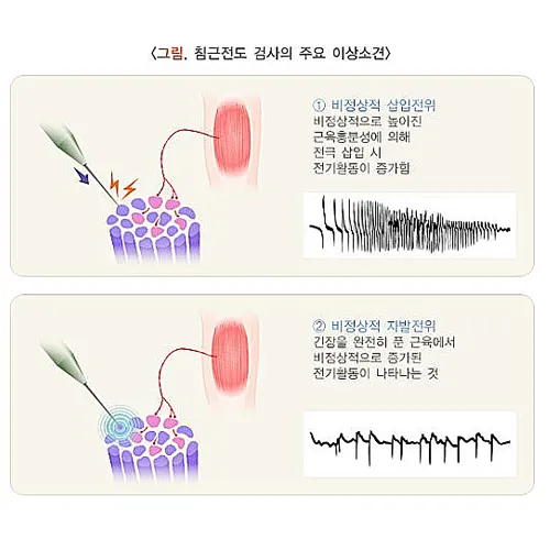 근전도 검사