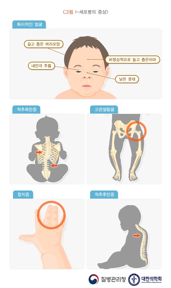 뮤코리피드증과 뮤코리지질증