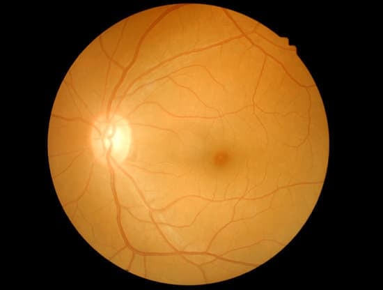 냉동 응고술(Cryopexy)