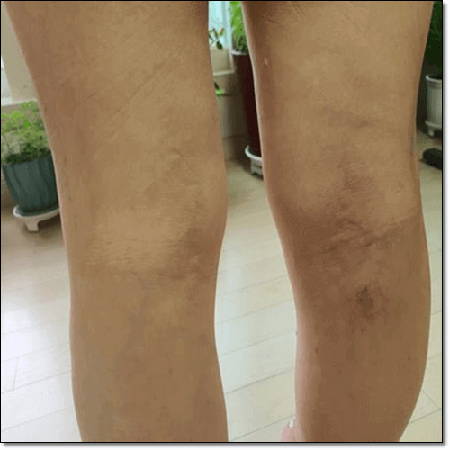 하지정맥류 환자