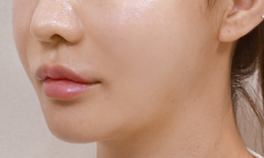 모공줄이는법 피부과 여드름흉터시술