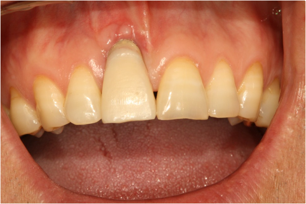 임플란트 부작용