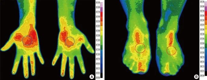 손발 온도차 건강 신호