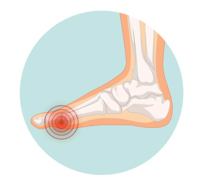 무지외반증 위치