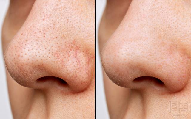 코팩 후 관리 코팩 모공 넓어짐 부작용 블랙헤드