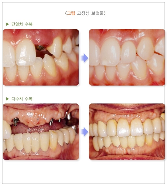 임플란트 의료보험적용 총정리