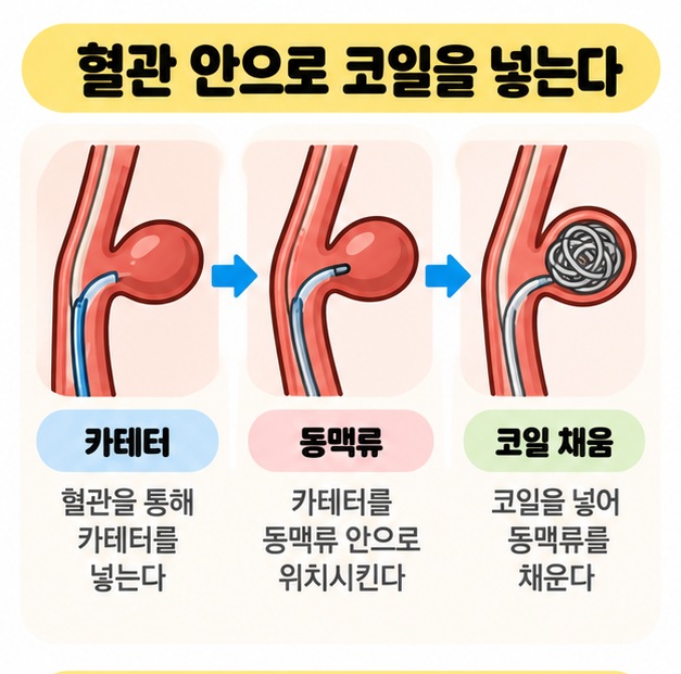 카테터를 혈관을 따라 뇌동맥류까지 넣고 내부를 코일로 채워 혈류를 차단하는 과정을 보여주는 카드