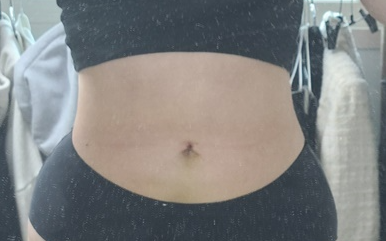 복부지방흡입 후기