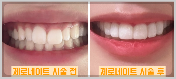 제로네이트와 라미네이트 차이점