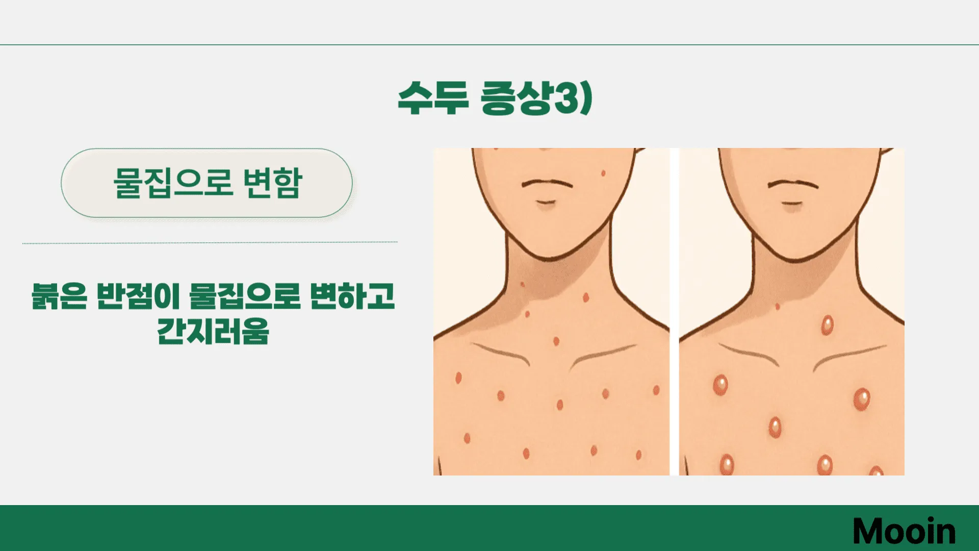 수두 증상3)
